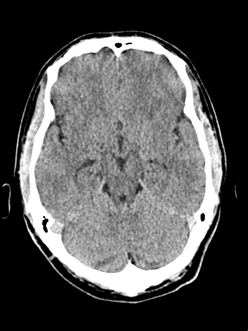 Normal trauma protocol brain and C-spine CT (Radiopaedia 83302-97709 Axial non-contrast 47).jpg