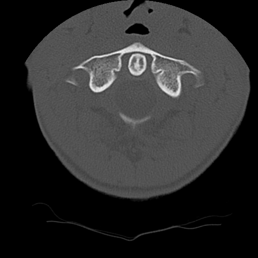Normal trauma spine imaging (age 16) (Radiopaedia 45335-49358 Axial bone window 10).jpg