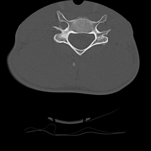 Normal trauma spine imaging (age 16) (Radiopaedia 45335-49358 Axial bone window 53).jpg
