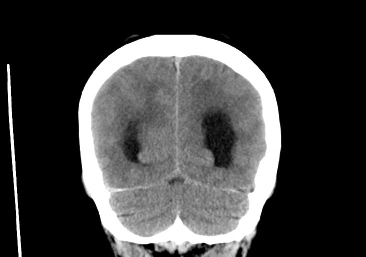 File:Obstructive hydrocephalus (Radiopaedia 30453-31119 Coronal non-contrast 32).jpg