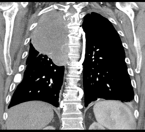 File:Obstructive superior vena cava tumor thrombus (Radiopaedia 28046-28306 B 35).jpg