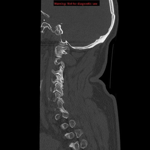 File:Occipital condyle fracture (Radiopaedia 18366-18208 Sagittal bone window 30).jpg