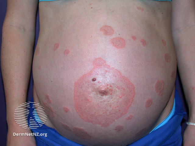 File:Pemphigoid gestationis (DermNet NZ immune-pemgest1).jpg