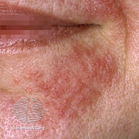 File:Perioral dermatitis (DermNet NZ acne-perioral-dermatitis-3402).jpg