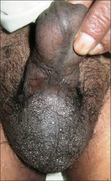 File:Slightly translucent vesicles of lymphangiectasia scrotum.png