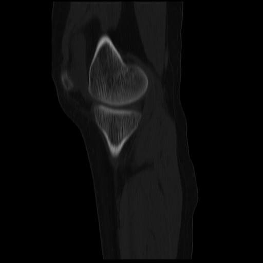 File:ACL avulsion fracture (Radiopaedia 33833-34994 Sagittal bone window 32).jpg