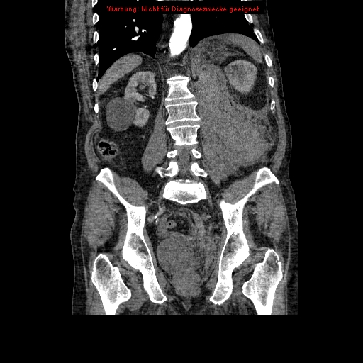 Abdominal aortic aneurysm- extremely large, ruptured (Radiopaedia 19882-19921 Coronal C+ arterial phase 70).jpg