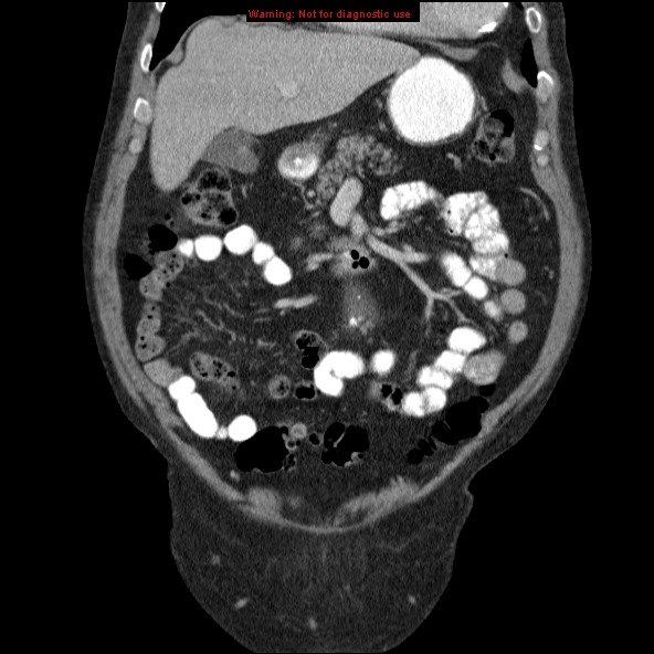 File:Abdominal aortic aneurysm (Radiopaedia 10122-10660 Coronal C+ portal venous phase 3).jpg