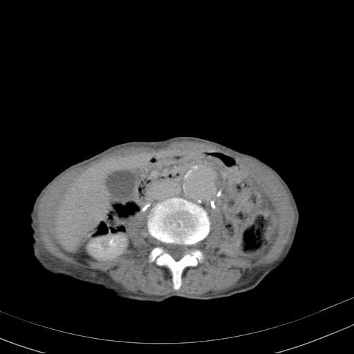 File:Abdominal aortic aneurysm (Radiopaedia 20827-20742 Axial C+ delayed 16).jpg