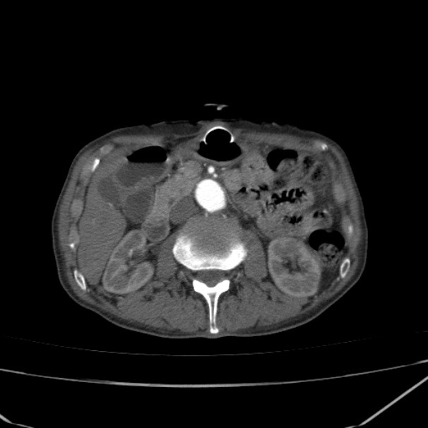 Abdominal aortic aneurysm (Radiopaedia 23703-23856 Axial C+ arterial phase 32).jpg