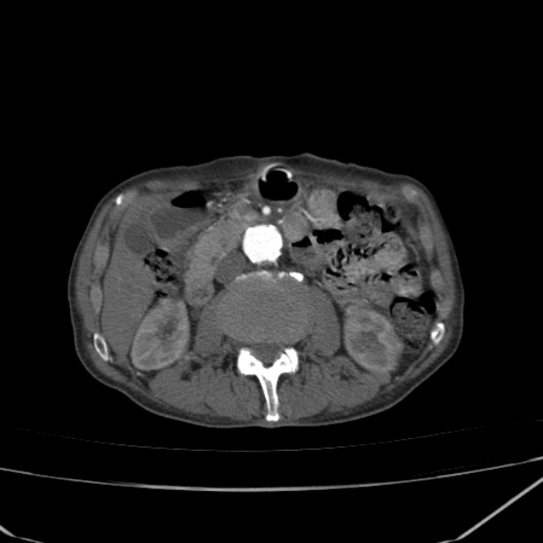 Abdominal aortic aneurysm (Radiopaedia 23703-23856 Axial C+ arterial phase 34).jpg