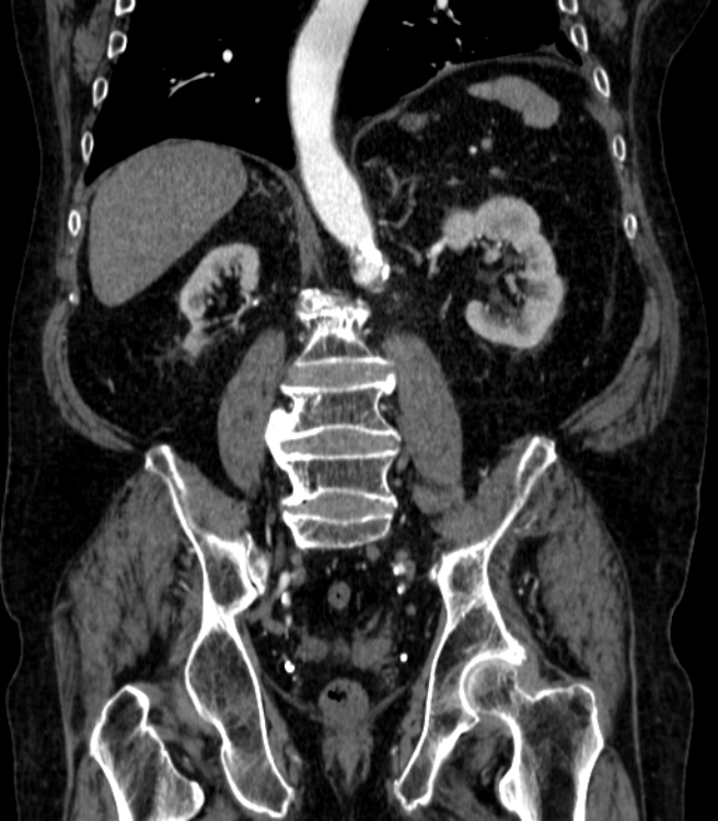 Abdominal aortic aneurysm (Radiopaedia 25855-26001 Coronal C+ arterial phase 47).jpg