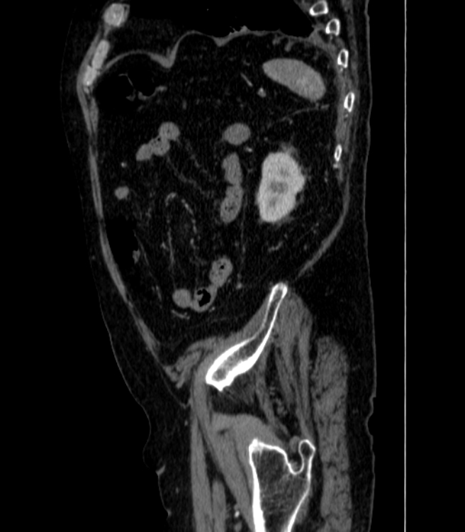 Abdominal aortic aneurysm (Radiopaedia 25855-26001 Sagittal C+ arterial phase 73).jpg