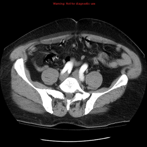 Abdominal aortic aneurysm (Radiopaedia 8190-9038 Axial C+ arterial phase 58).jpg