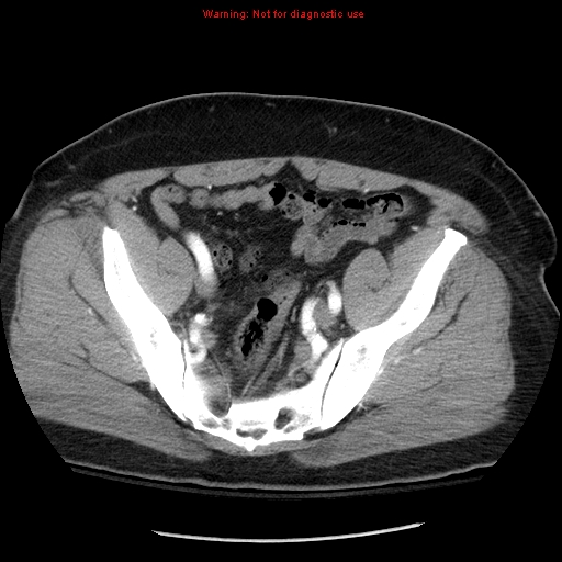 Abdominal aortic aneurysm (Radiopaedia 8190-9038 Axial C+ arterial phase 68).jpg