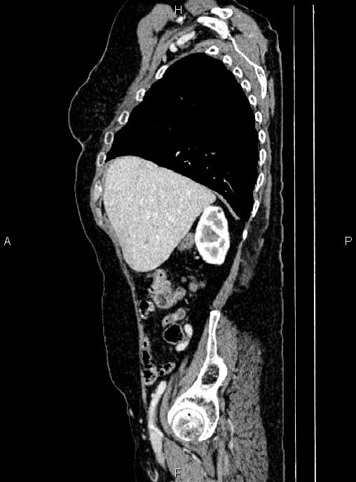 Abdominal aortic aneurysm (Radiopaedia 85063-100606 Sagittal C+ arterial phase 17).jpg