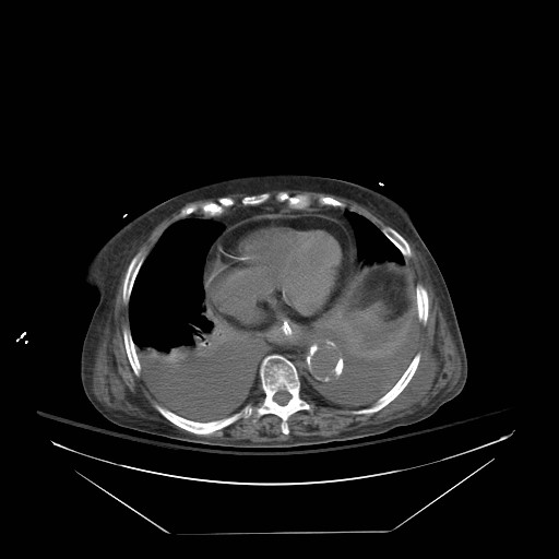 File:Abdominal aortic aneurysm - impending rupture (Radiopaedia 19233-19247 Axial non-contrast 23).jpg