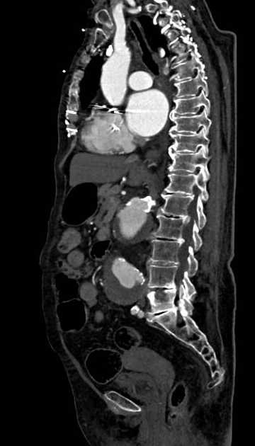 Abdominal aortic aneurysm with thrombus fissuration (Radiopaedia 73192-83919 Sagittal C+ arterial phase 72).jpg