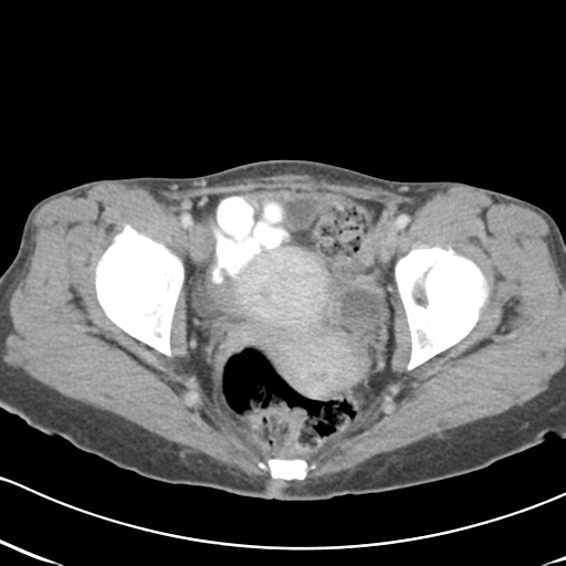 Abdominal desmoid tumor (Radiopaedia 41007-43740 Axial C+ portal venous phase 66).png