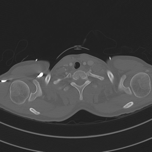 File:Abdominal multi-trauma - devascularised kidney and liver, spleen and pancreatic lacerations (Radiopaedia 34984-36486 I 8).png