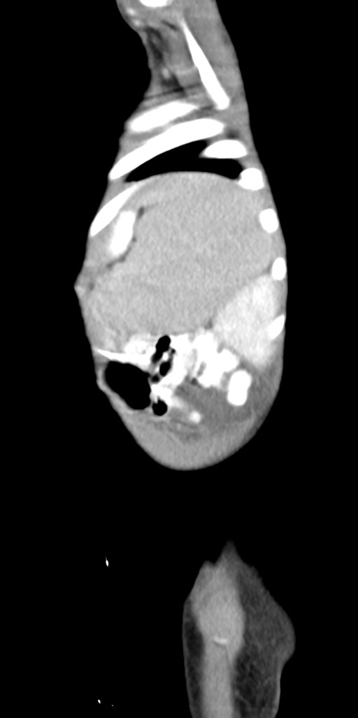 Abdominopelvic rhabdomyosarcoma (Radiopaedia 78356-90984 Sagittal C+ portal venous phase 13).jpg