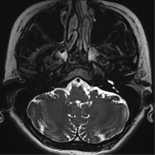 File:Abducens nerve palsy (Radiopaedia 51069-56648 Axial T2 fat sat 8).png