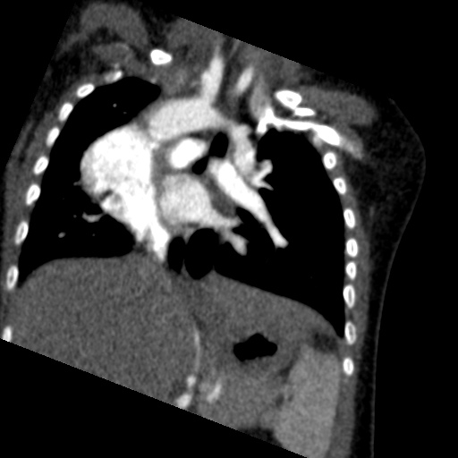 File:Aberrant left pulmonary artery (pulmonary sling) (Radiopaedia 42323-45435 Coronal C+ CTPA 13).jpg