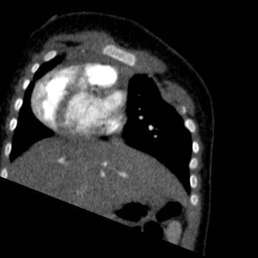 File:Aberrant left pulmonary artery (pulmonary sling) (Radiopaedia 42323-45435 Coronal C+ CTPA 19).jpg