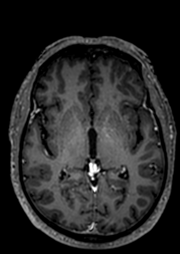 Accessory middle cerebral artery (Radiopaedia 73114-83828 Axial T1 C+ 36).jpg