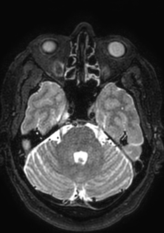 Accessory middle cerebral artery (Radiopaedia 73114-83828 Axial T2 152).jpg