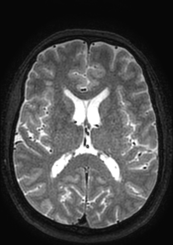 File:Accessory middle cerebral artery (Radiopaedia 73114-83828 Axial T2 50).jpg
