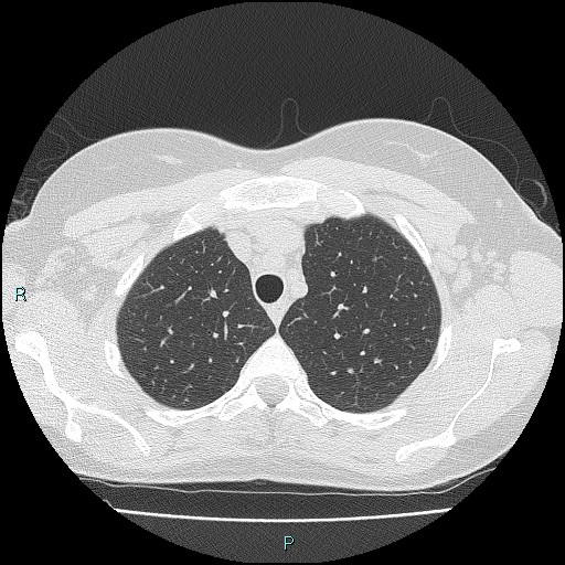 Accidental foreign body aspiration (seamstress needle) (Radiopaedia 77740-89983 Axial lung window 14).jpg