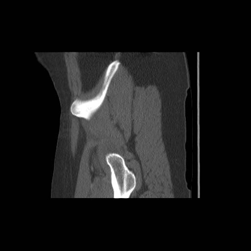 File:Acetabular fracture (Radiopaedia 13193-13212 Sagittal bone window 13).jpg