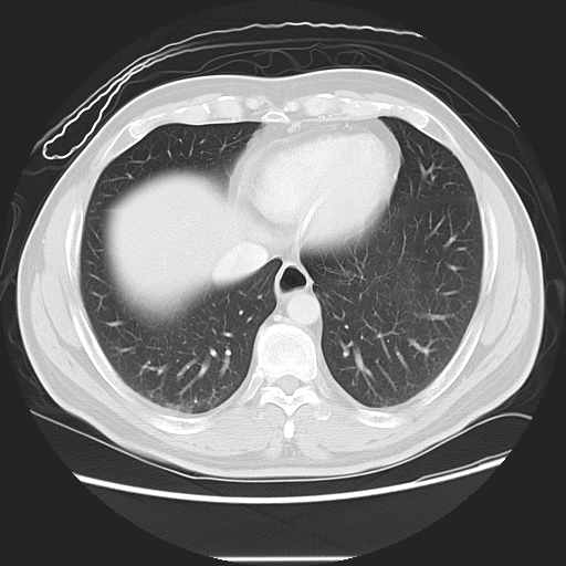 Achalasia (Radiopaedia 8831-9629 Axial lung window 45).jpg