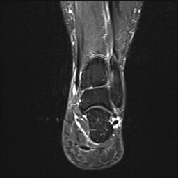 File:Achilles tendon tear (Radiopaedia 77615-89819 Coronal STIR 18).jpg