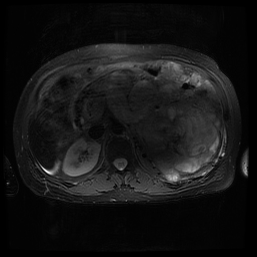 Acinar cell carcinoma of the pancreas (Radiopaedia 75442-86668 Axial T2 fat sat 34).jpg