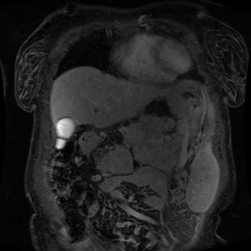 Acinar cell carcinoma of the pancreas (Radiopaedia 75442-86668 Coronal T1 C+ fat sat 143).jpg