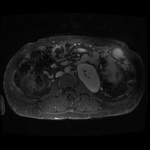 Acinar cell carcinoma of the pancreas (Radiopaedia 75442-86668 D 11).jpg