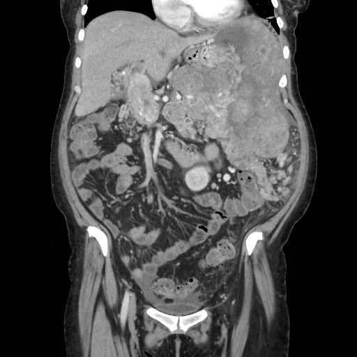 Acinar cell carcinoma of the pancreas (Radiopaedia 75442-86669 Coronal C+ portal venous phase 49).jpg