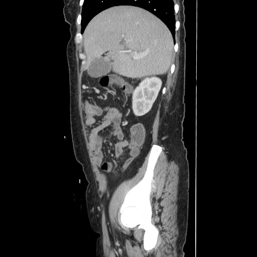 Acinar cell carcinoma of the pancreas (Radiopaedia 75442-86669 Sagittal C+ portal venous phase 59).jpg