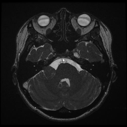 Acoustic neuroma (Radiopaedia 34049-35283 Axial 59).png
