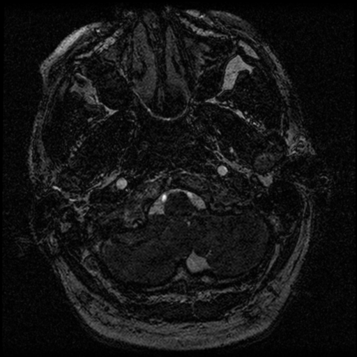 File:Acoustic schwannoma (Radiopaedia 39170-41387 Axial FIESTA 14).png