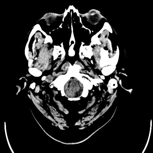 File:Acoustic schwannoma (Radiopaedia 39170-41389 Axial non-contrast 1).png