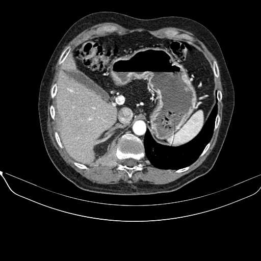 File:Acquired adrenal hyperplasia - due to thymic carcinoid tumor (Radiopaedia 21269-21184 C+ arterial phase 22).jpg