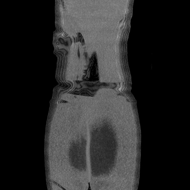 Active colonic bleed on CT (Radiopaedia 49765-55025 Coronal art MIP 62).jpg