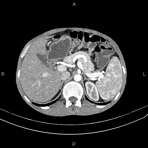 Active crohn disease (Radiopaedia 87133-103397 Axial C+ arterial phase 31).jpg