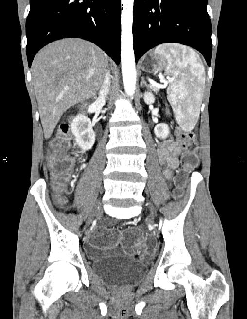 Active crohn disease (Radiopaedia 87133-103397 Coronal C+ arterial phase 39).jpg