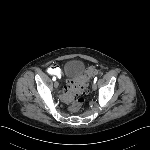 Active lower gastrointestinal bleeding - diverticular (Radiopaedia 61203-69106 Axial C+ arterial phase 53).jpg