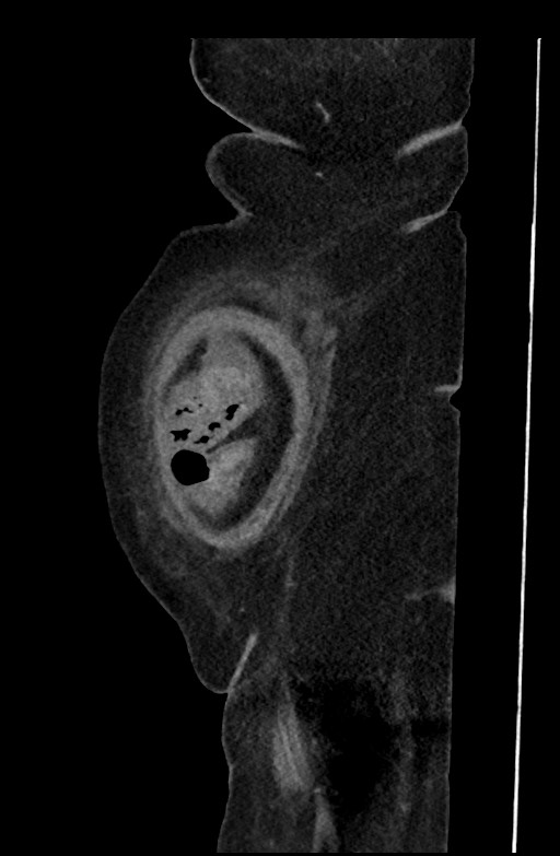 Active renal extravasation with large subcapsular and retroperitoneal hemorrhage (Radiopaedia 60975-68796 Sagittal C+ portal venous phase 200).jpg