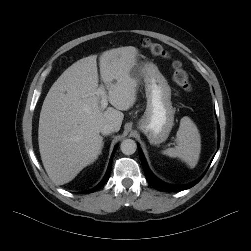 Acute-on-chronic pancreatitis (Radiopaedia 67286-76656 Axial C+ portal venous phase 18).jpg